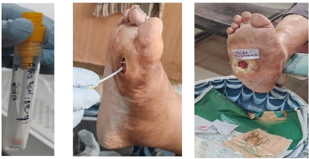 Collection of Samples from Patients with Leprosy Ulcers